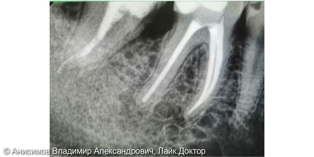 Лечение пульпита зуб 3.6 - фото №2