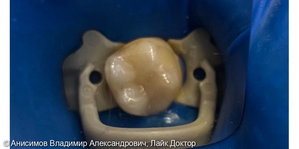 Лечение кариеса постояного зуба - фото №2