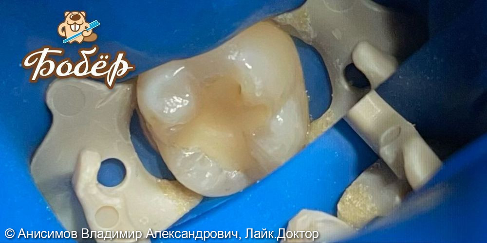 Лечение кариеса зуб 36 - фото №1