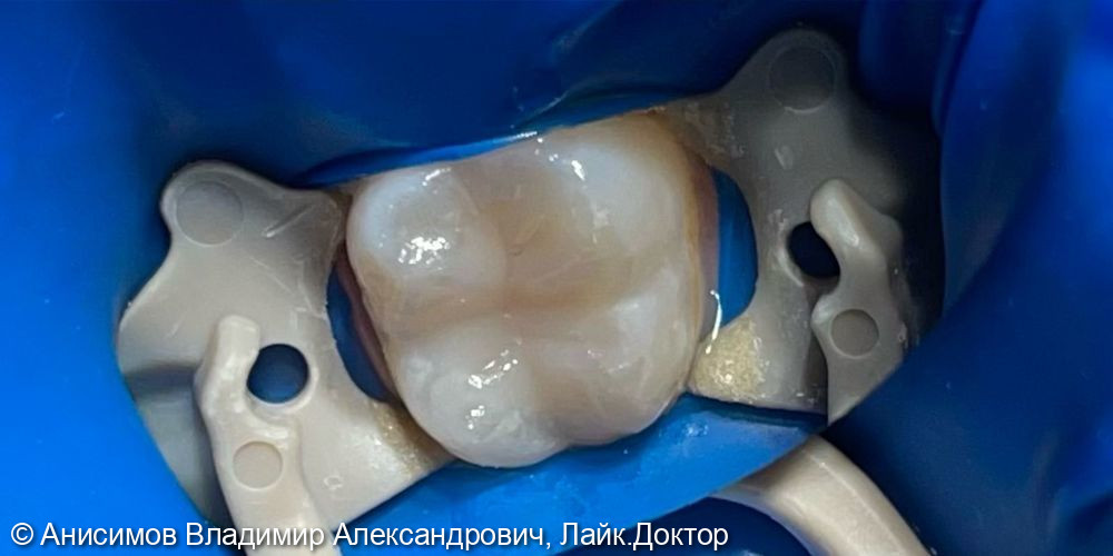 Лечение кариеса зуб 36 - фото №2
