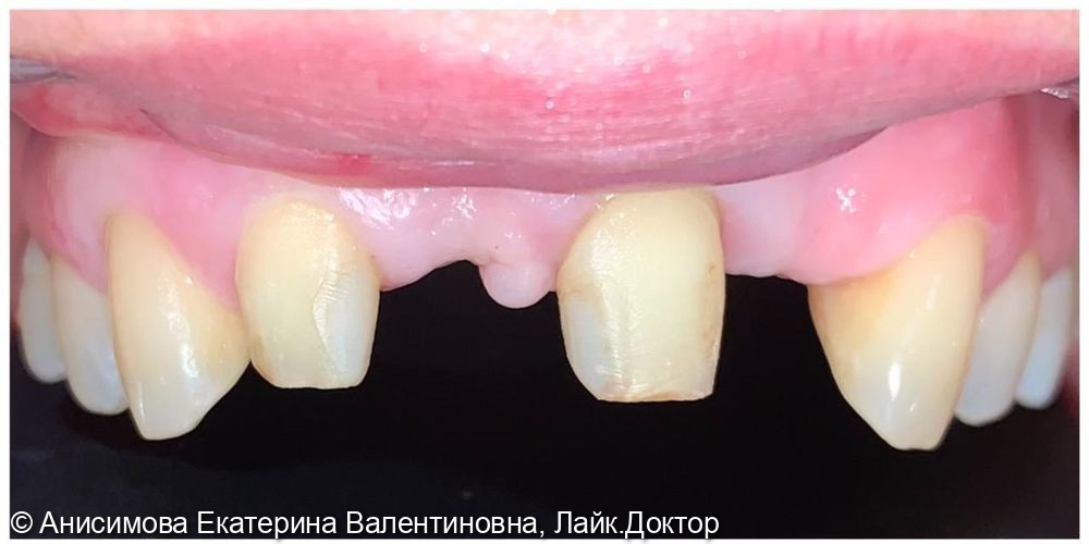 Частичная адентия зубов на верхней челюсти - фото №1