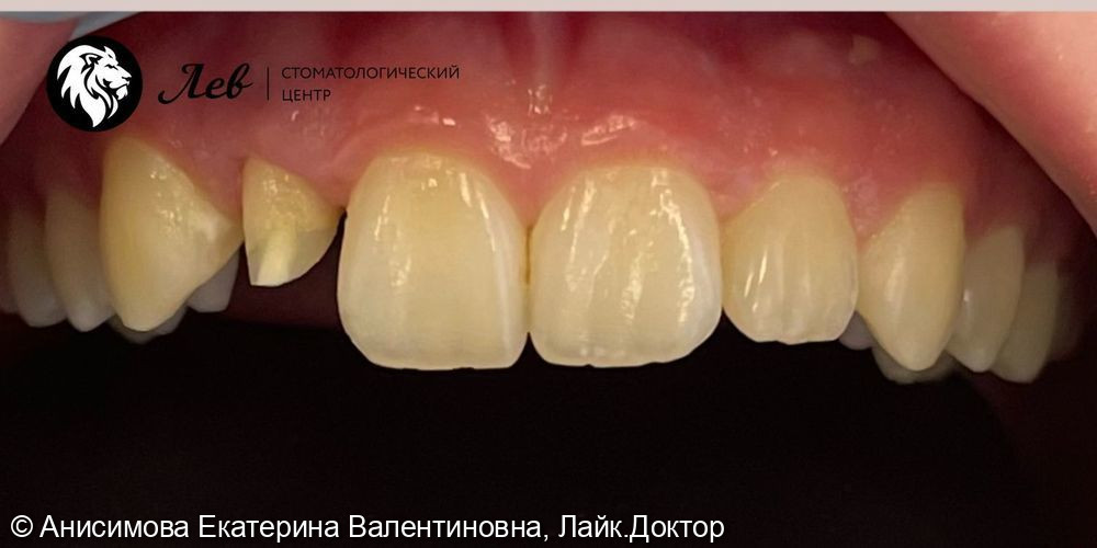 Восстановление коронковой части зуба циркониевой коронкой - фото №1