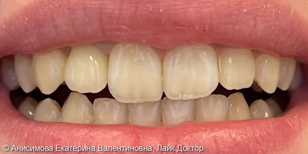 Восстановление коронковой части зуба циркониевой коронкой - фото №2