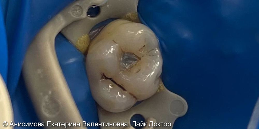 Лечение кариеса постоянного зуба 2.6 - фото №1