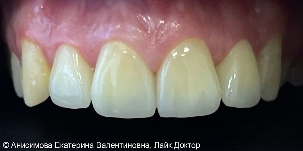 Реабилитация улыбки на верхней челюсти циркониевыми коронками - фото №2