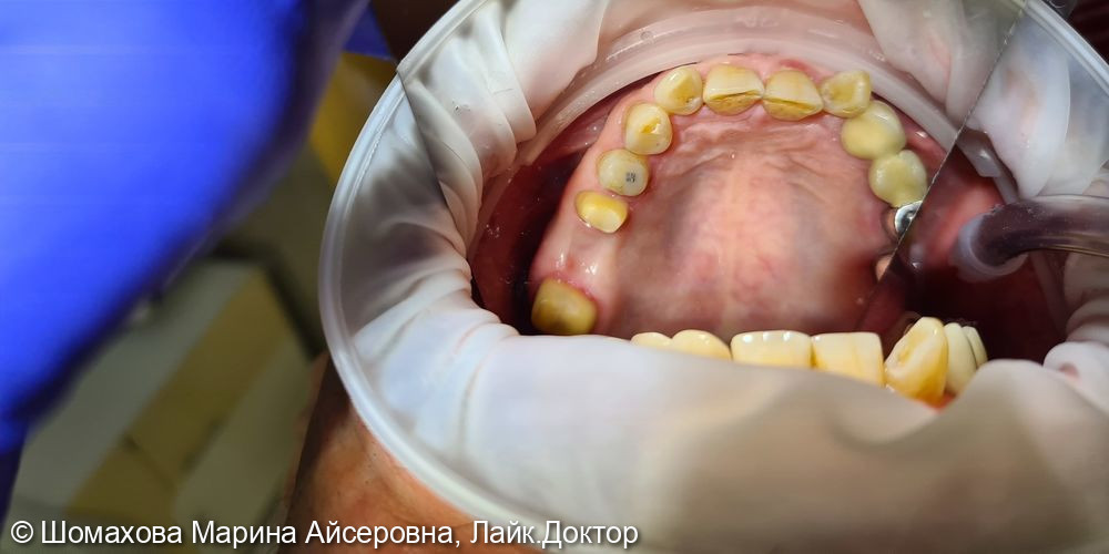 Пациент обратился с целью постановки мостовидной коронки, т. к. было удаление 26 зуба - фото №1