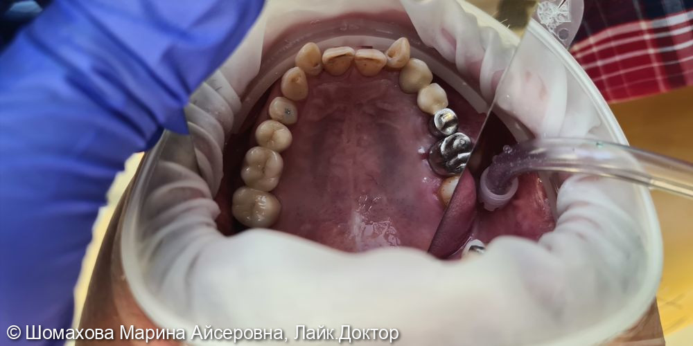 Пациент обратился с целью постановки мостовидной коронки, т. к. было удаление 26 зуба - фото №2