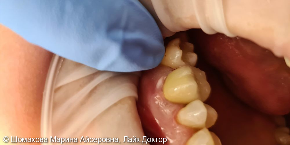 Пациент обратился с жалобами на выпадение пломбы, застревание пищи между зубами. 26 зуб был годами ранее депульпирован (удаляли нерв). Было принято решение восстановить зуб металлокерамической коронкой, т. к. стенки зуба значительно разрушены (во избежани - фото №3