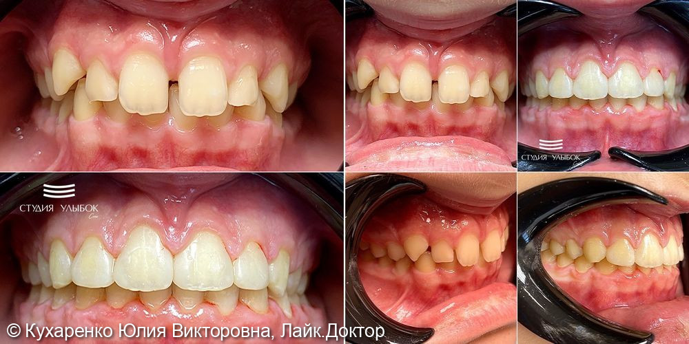 Результаты комплексного ортодонтического лечения у пациента 13-ти лет - фото №1