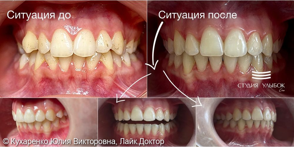 Лечение перекрестного прикуса - фото №2