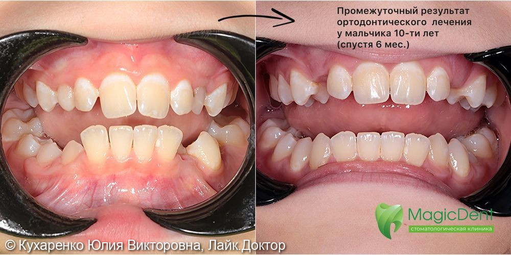 Промежуточный результат ортодонтического лечения неправильного прикуса у 10-ти летнего ребенка - фото №1