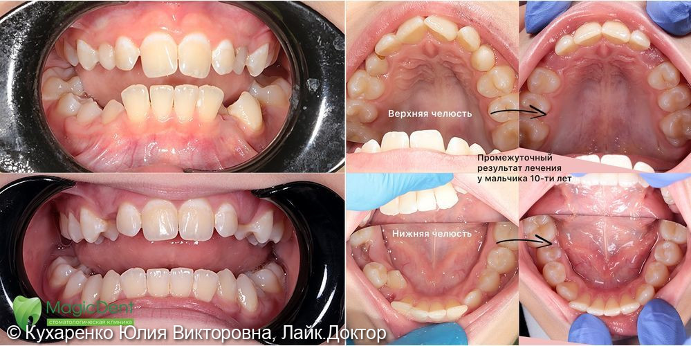 Промежуточный результат ортодонтического лечения неправильного прикуса у 10-ти летнего ребенка - фото №4