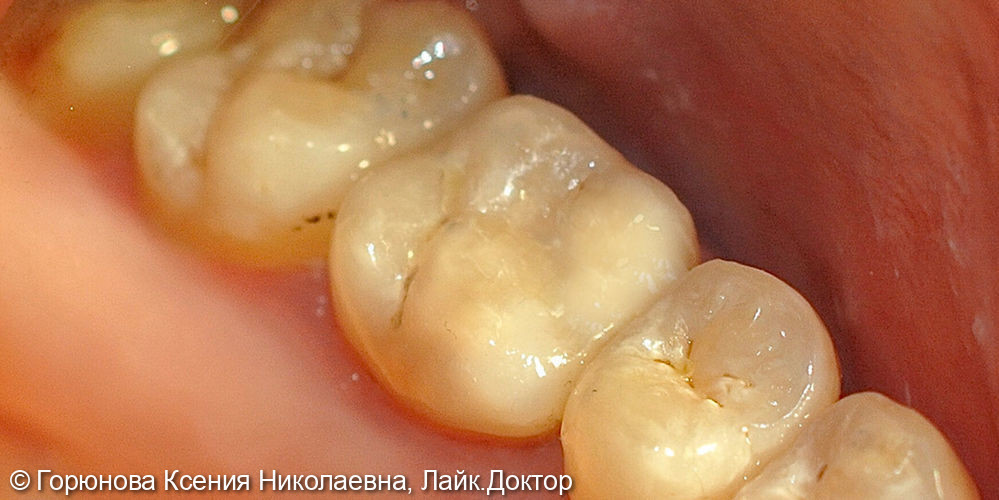 Лечение глубокого кариеса зуба 2.6 - фото №2