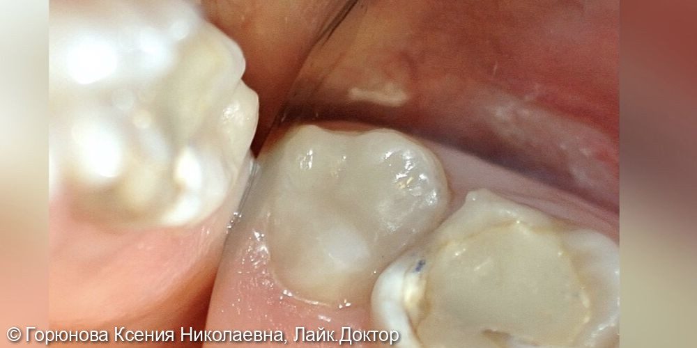 Лечение среднего кариеса зуб 2.8 - фото №2