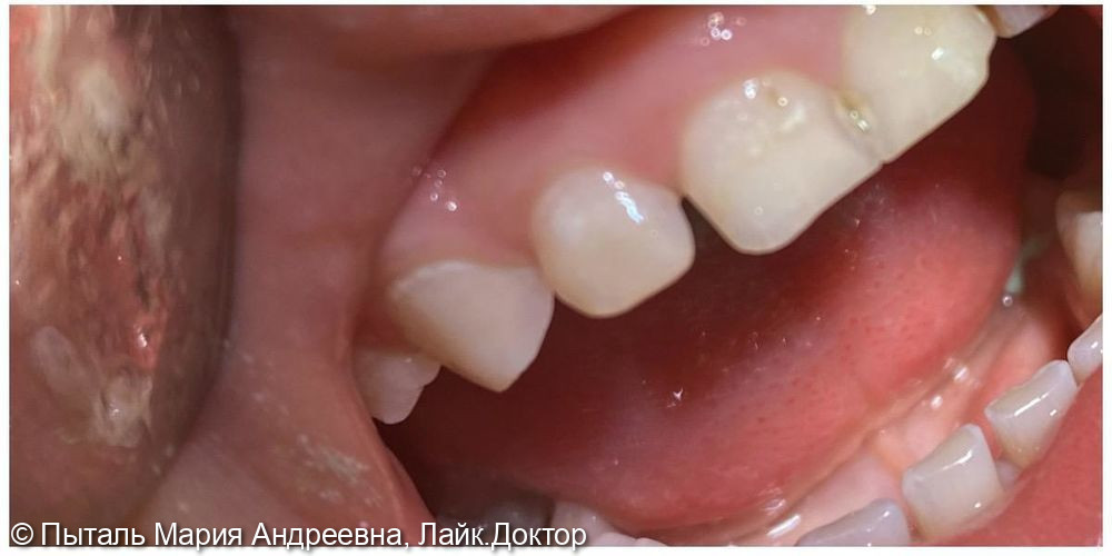 Лечение кариеса молочного зуба - фото №2