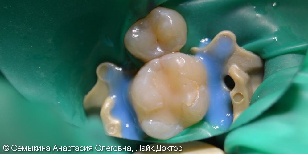 Лечение скрытого кариеса в зубах 15,16 с заменой старой несостоятельной пломбы в 16 зубе - фото №1