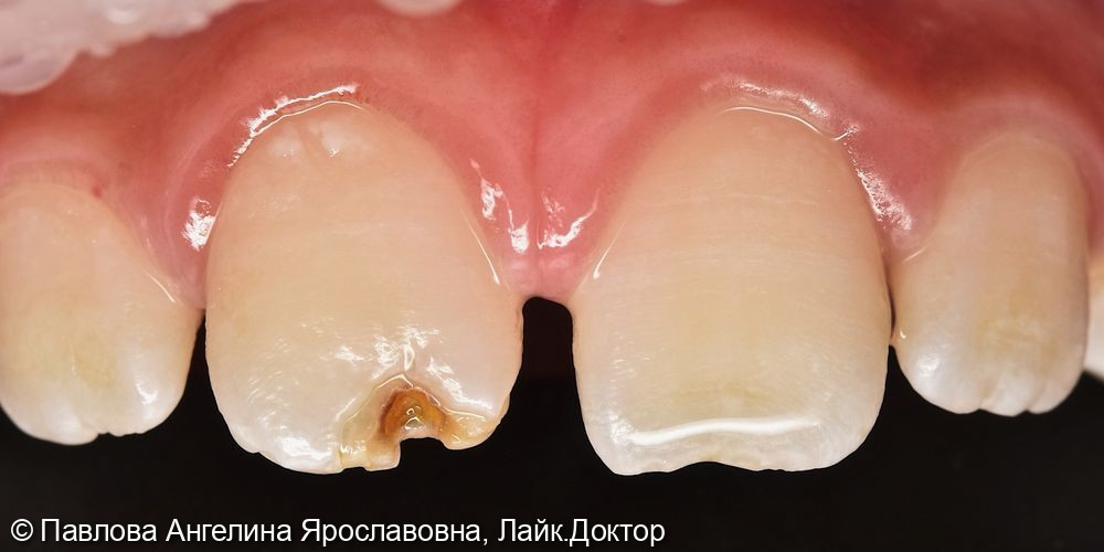Лечение переднего зуба у ребенка - фото №1