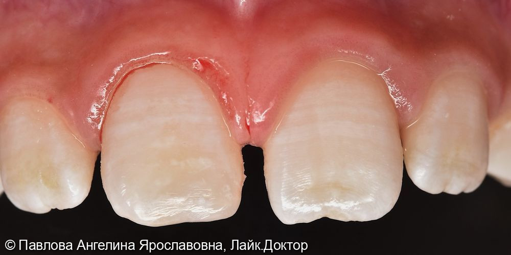 Лечение переднего зуба у ребенка - фото №2