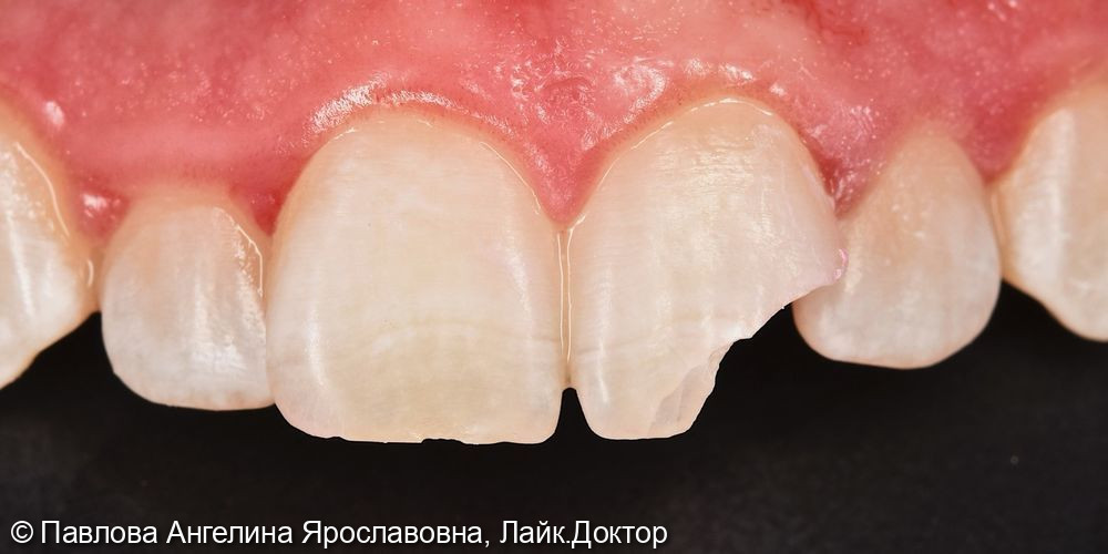 Скол переднего зуба - фото №1