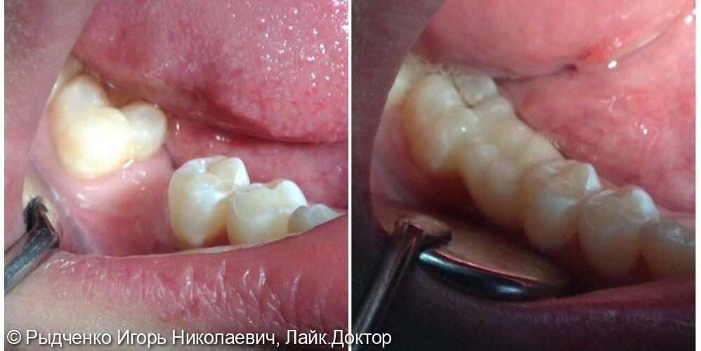 Восстановление 4.6. зуба методом адгезивной стекловолоконной техники - фото №1