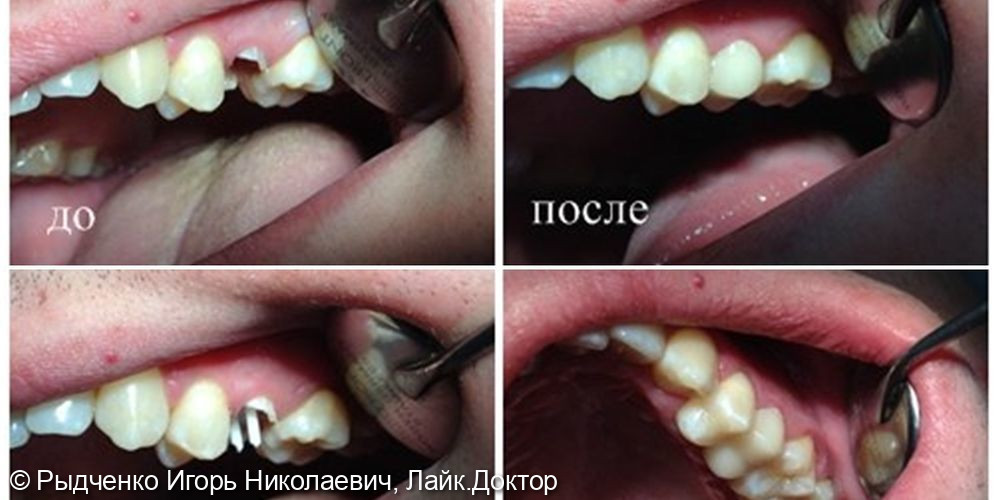 Лечение хр. периодонтита с последующим восстановлением коронковой части 2.5. зуба - фото №1