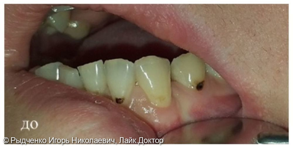 Лечение пришеечного кариеса боковых зубов нижней челюсти - фото №1