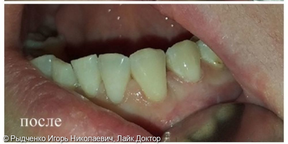 Лечение пришеечного кариеса боковых зубов нижней челюсти - фото №2