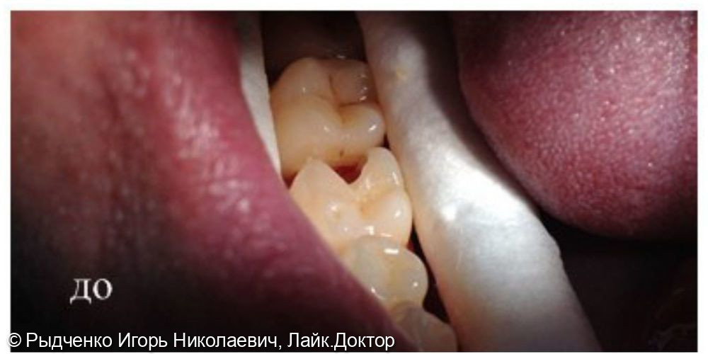 Лечение глубокого кариеса нижнего коренного зуба справа - фото №1