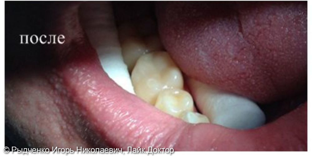 Лечение глубокого кариеса нижнего коренного зуба справа - фото №2