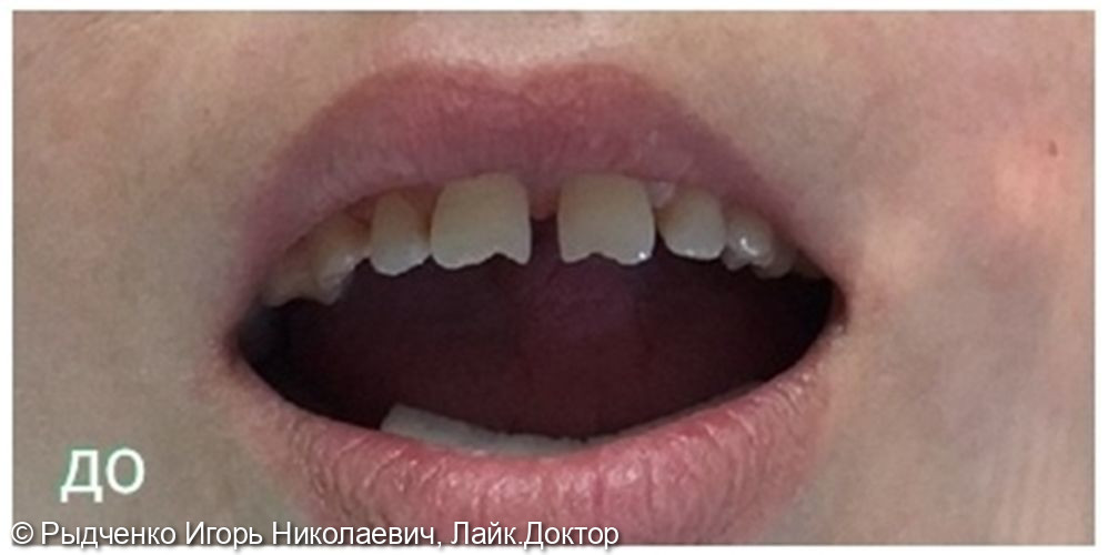 Реставрация верхних передних зубов, уменьшение диастемы - фото №1
