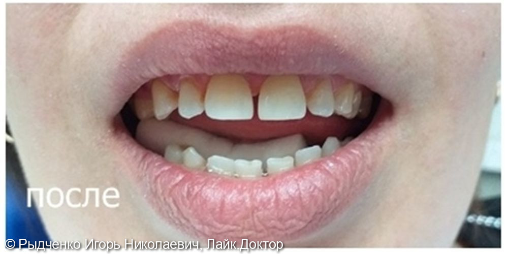 Реставрация верхних передних зубов, уменьшение диастемы - фото №2