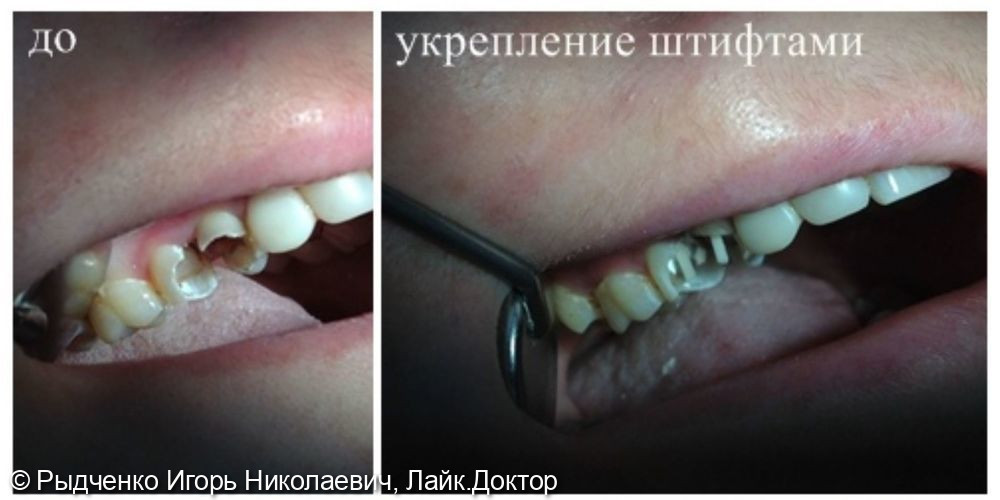 Реставрация малых коренных зубов верхней челюсти композитным материалом светового отверждения, с использованием внутриканальных стекловолоконных штифтов в качестве укрепляющих элементов - фото №1