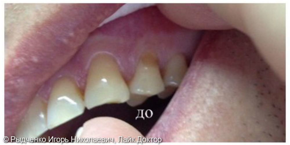Лечение клиновидного дефекта 2.4. зуба с использованием композита светового отверждения - фото №1