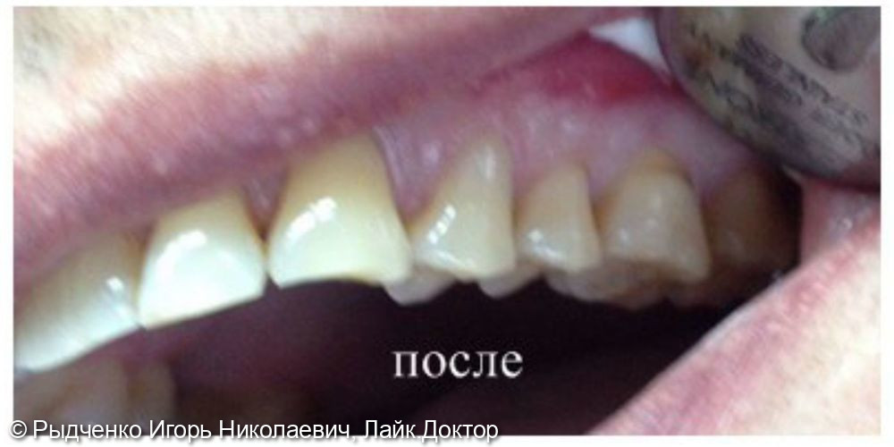 Лечение клиновидного дефекта 2.4. зуба с использованием композита светового отверждения - фото №2