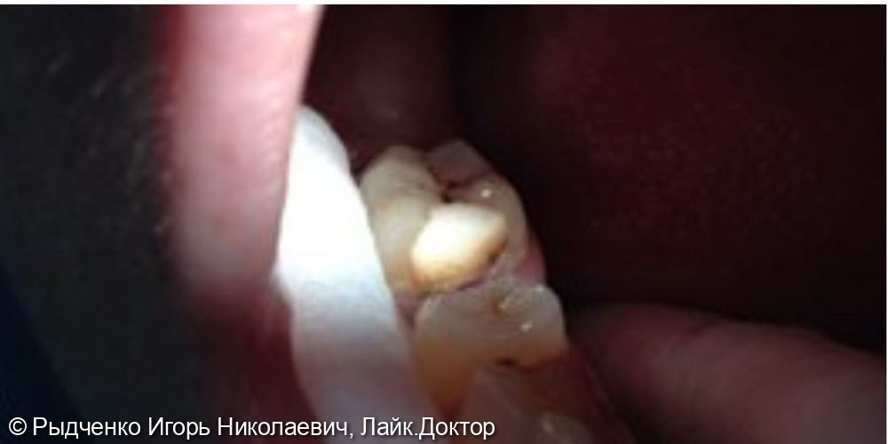 Лечение вторичного кариеса нижнего коренного зуба - фото №1
