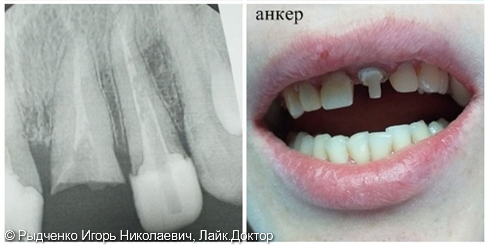 Восстановление верхнего центрального резца из композита светового отверждения - фото №2