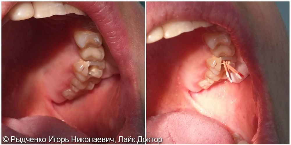 Лечение коренного пульпитного зуба верхней челюсти - фото №1