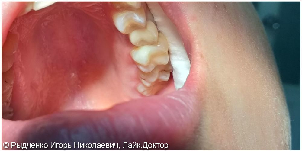 Лечение коренного пульпитного зуба верхней челюсти - фото №2