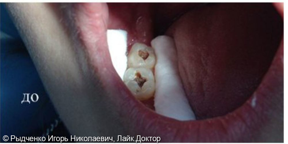 Лечение глубокого кариеса 4.7, 4.8. зубов - фото №1