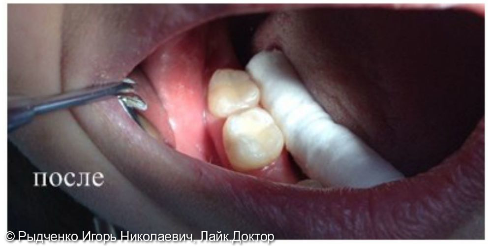 Лечение глубокого кариеса 4.7, 4.8. зубов - фото №2