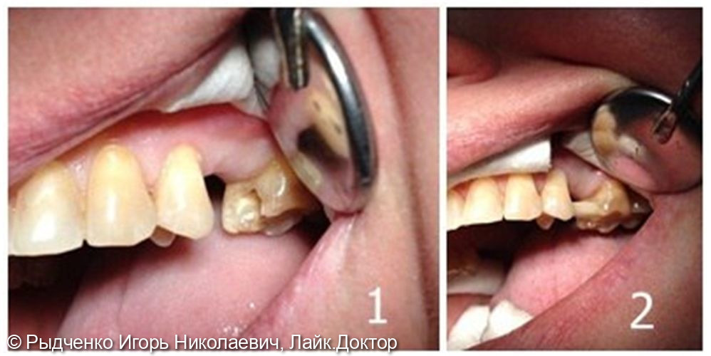 Восстановление отсутствующего 2.5 зуба методом адгезивной стекловолоконной техники из светокомпозита - фото №1