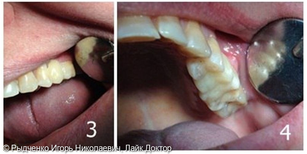 Восстановление отсутствующего 2.5 зуба методом адгезивной стекловолоконной техники из светокомпозита - фото №2