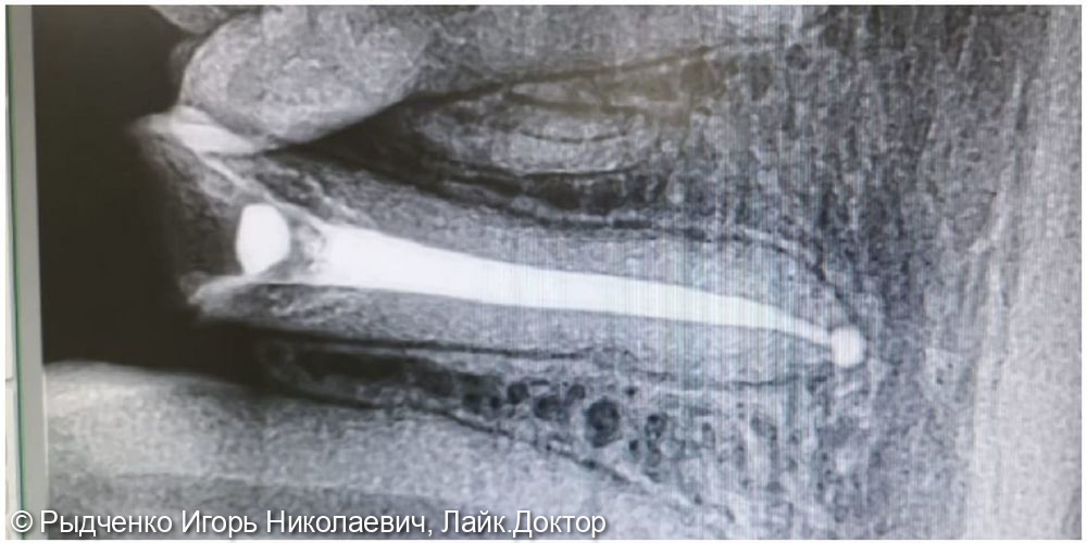 Восстановление разрушенного нижнего малого коренного зуба на сохранённом корне из композита светового отверждения - фото №2