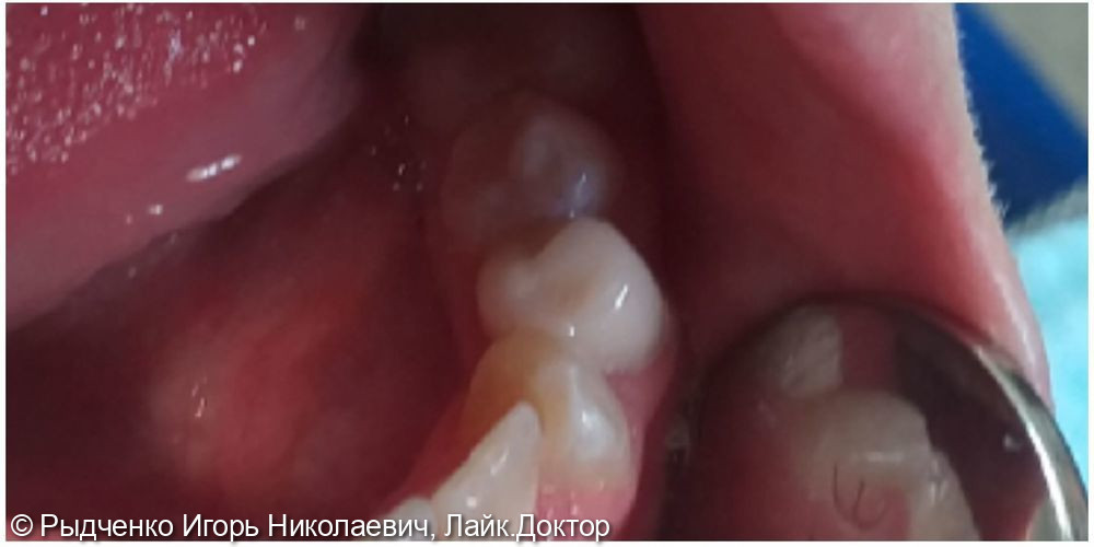 Восстановление разрушенного нижнего малого коренного зуба на сохранённом корне из композита светового отверждения - фото №4