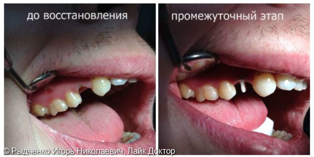 Восстановление полностью разрушенного малого коренного зуба верхне челюсти на основе сохранённого, вылеченного корня - фото №1