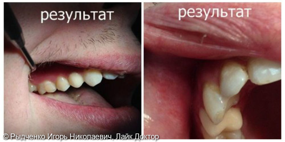 Восстановление полностью разрушенного малого коренного зуба верхне челюсти на основе сохранённого, вылеченного корня - фото №2