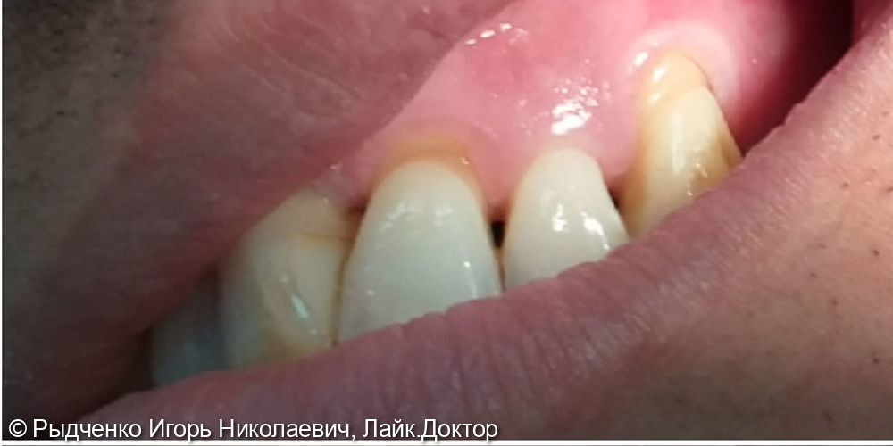 Лечение клиновидных дефектов двух фронтальных зубов с применением композита светового отверждения - фото №1