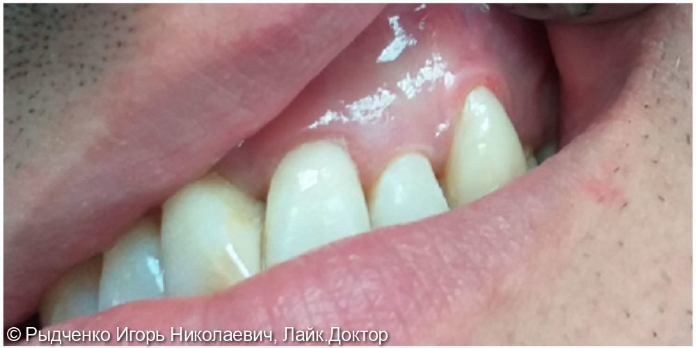 Лечение клиновидных дефектов двух фронтальных зубов с применением композита светового отверждения - фото №2