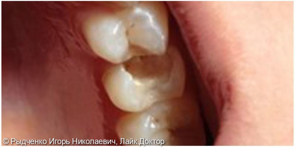 Лечение пульпита малого коренного верхнего зуба слева - фото №1