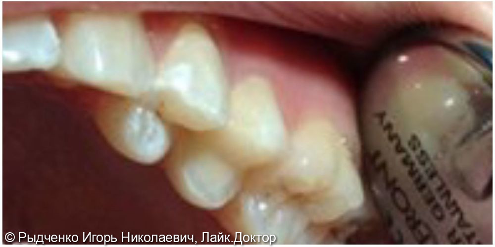 Лечение пульпита малого коренного верхнего зуба слева - фото №2